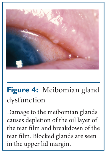 Dry eye: meibomian gland dysfunction