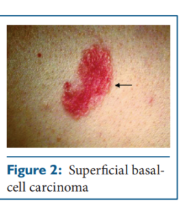 Basal cell carcinoma