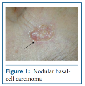 Basal cell cancer