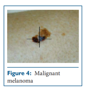 malignant melanoma
