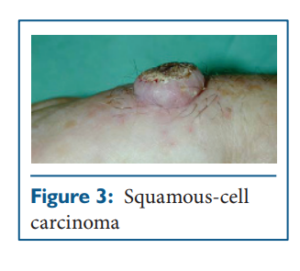 Squamous cell carcinoma