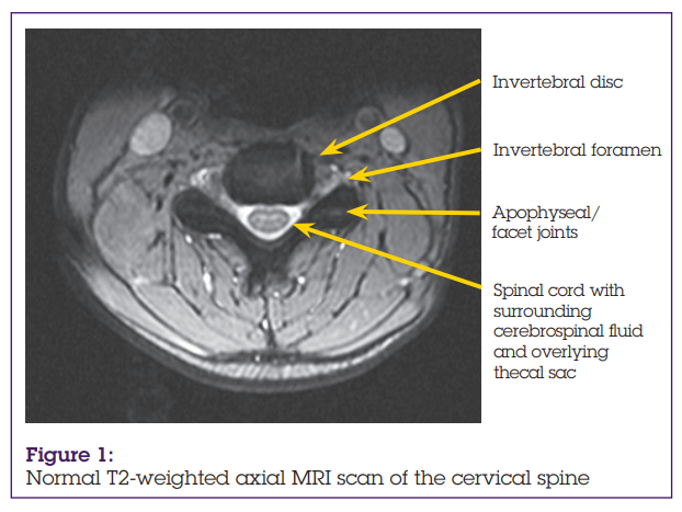 Back pain: MRI scan of the cervical spine