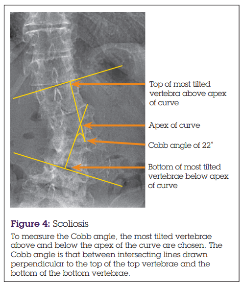 Scoliosis