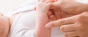 Baby with childhood eczema