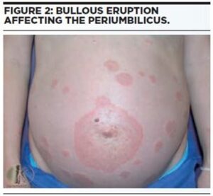 Bullous eruption in pregnancy