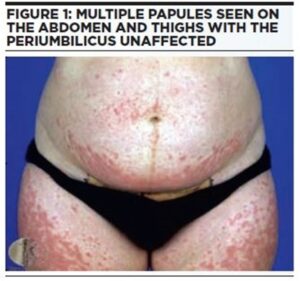 Multiple papules in pregnancy