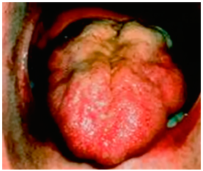 Figure 2 - Bilateral tongue wasting in a patient with MND