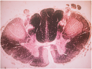 Figure 3 - Spinal cord cross-section of a patient with MND. Note the pale anterior horns and antero-lateral corticospinal tracts