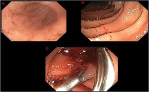 Heyde syndrome