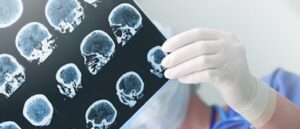Alzheimer's disease, brain scan