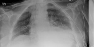 muscle tension dysphonia