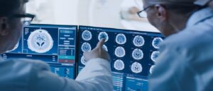 Doctors looking at a brain scan of a stroke