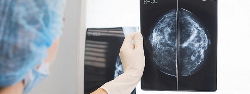 Scan showing breast cancer