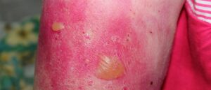 bullous pemphigoid