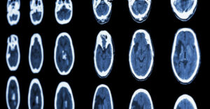 Scan of stroke