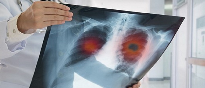 doctor holding image of lung x-ray