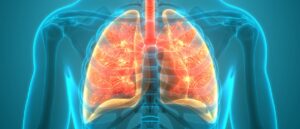 Abstract image showing lung cancer, lung disease, pulmonary embolism