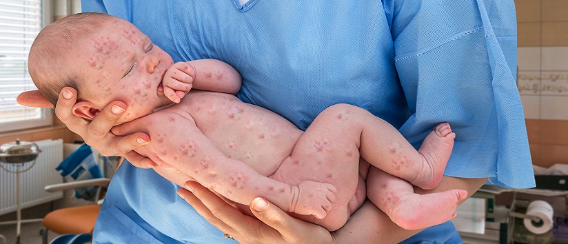 Measles in new born baby