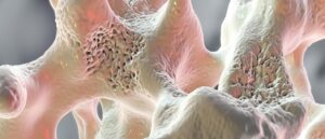 bones, osteoporosis, bone loss