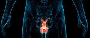 prostate cancer