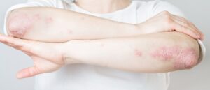 psoriasis, autoimmune disease