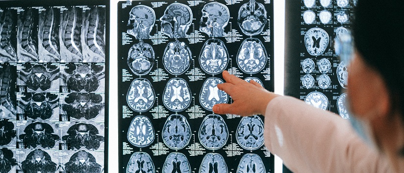 brain scan, Alzheimer's disease