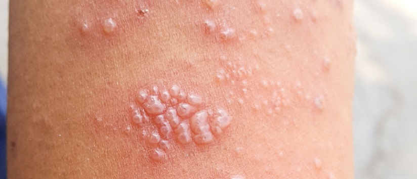 Shingles rash