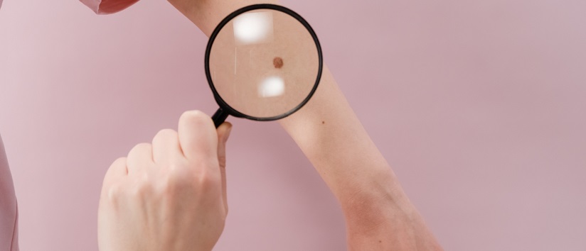 Diagnosing skin cancer