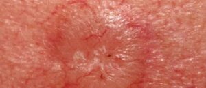 skin cancer