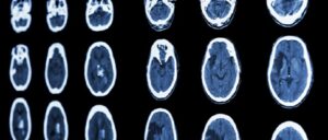 brain scan, stroke