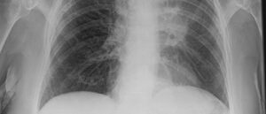 Veil sign on scan