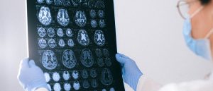 What is NMOSD? A rare disease commonly misdiagnosed as MS