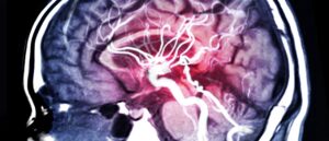MRI scan of brain, Alzheimer's, dementia, neurology