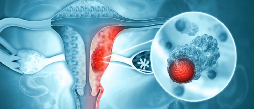 Abstract image of endometrial cancer