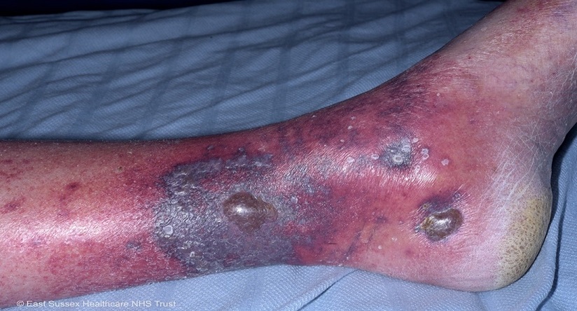 vasculitis on leg