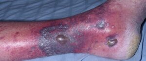 Vasculitis on leg
