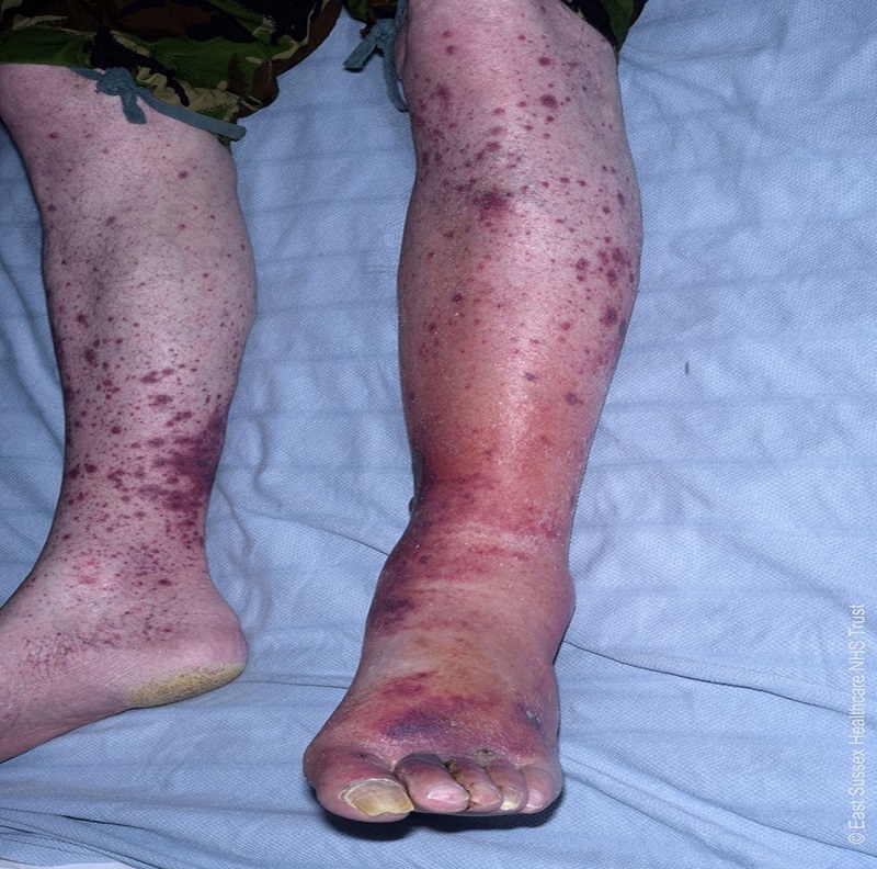 Vasculitis on legs