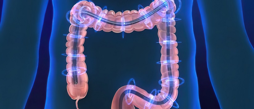 Colonoscopy, a long, fleible tube (colonoscope) is inserted into the rectum. 3D illustration