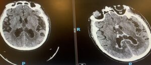 CASE STUDY stroke mimics image