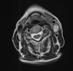 MRI scan