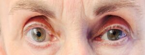 Unilateral Ptosis and Miosis