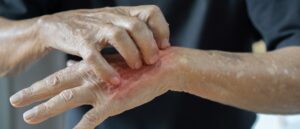 scabies, itchy skin