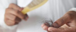 alopecia, hair loss