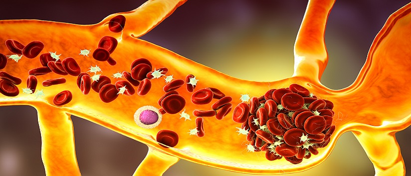 Abstract image of artery with cholesterol and a blood clot