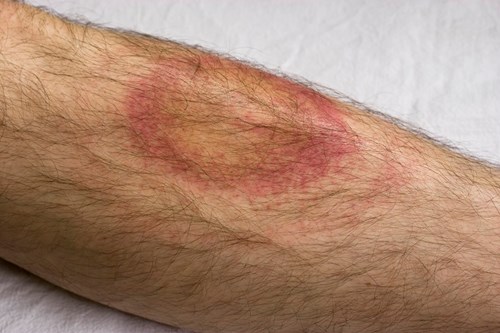 Insect bite, lyme disease
