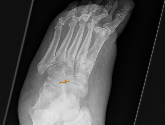 Müller–Weiss disease