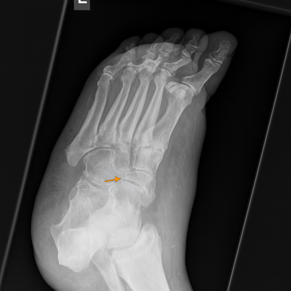 Müller–Weiss disease