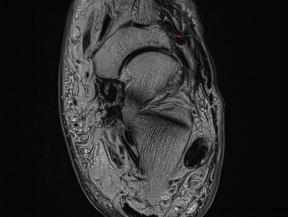 Müller–Weiss disease